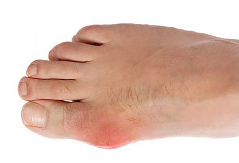 Cherries – the natural way to stop gout